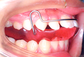 機能的矯正装置を使用して、前歯の突出を抑え、下顎の成長方向を誘導しています