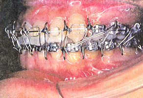 顎離断術を行いました、手術直後は上下の歯列をワイヤーで固定します（半日）